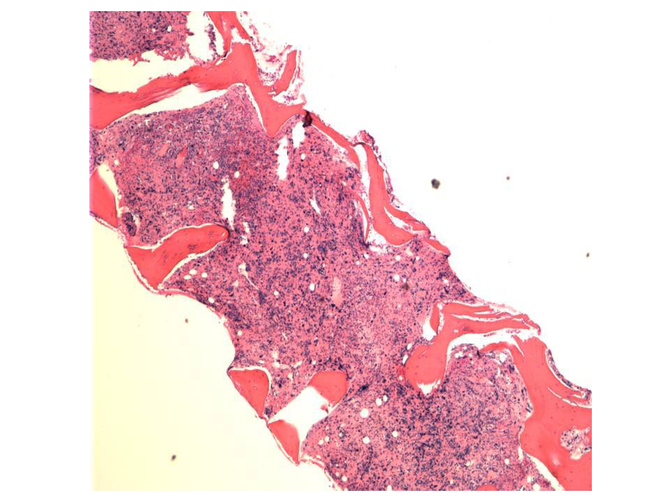 The marrow shows increased cellularity (~60-70%).